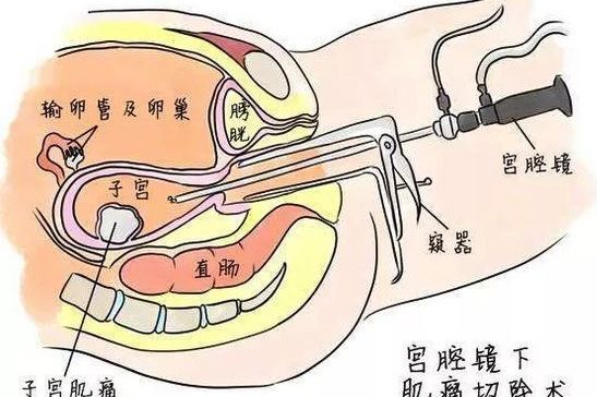 宫腔镜手术长什么样？术后要注意什么？ ​