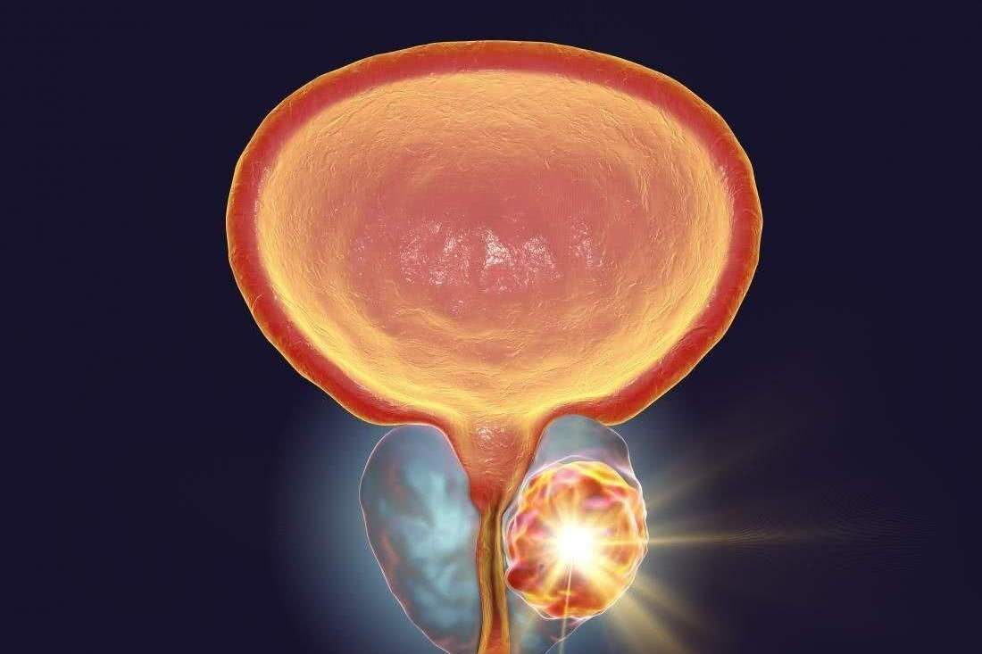 高脂肪饮食可导致前列腺癌加速恶化