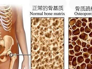 预防骨质疏松的几个关键点