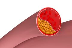 治疗颈动脉斑块，吃药不是为了“化”掉它，而是让它变更“硬”
